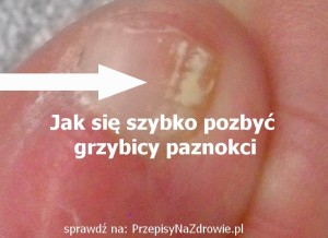 przepisynazdrowie.pl-jak-szybko-wyleczyc-grzybice-paznokci